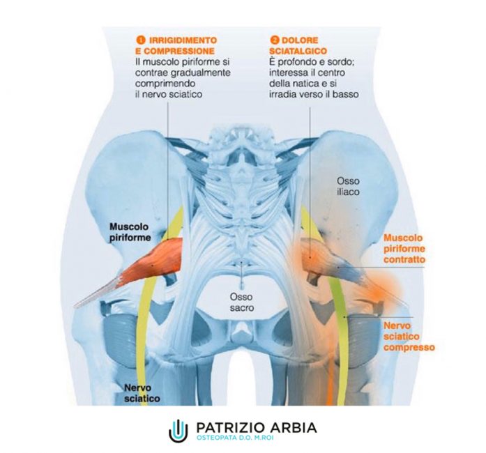 Sindrome Del Piriforme E Trattamento Osteopatico 7805